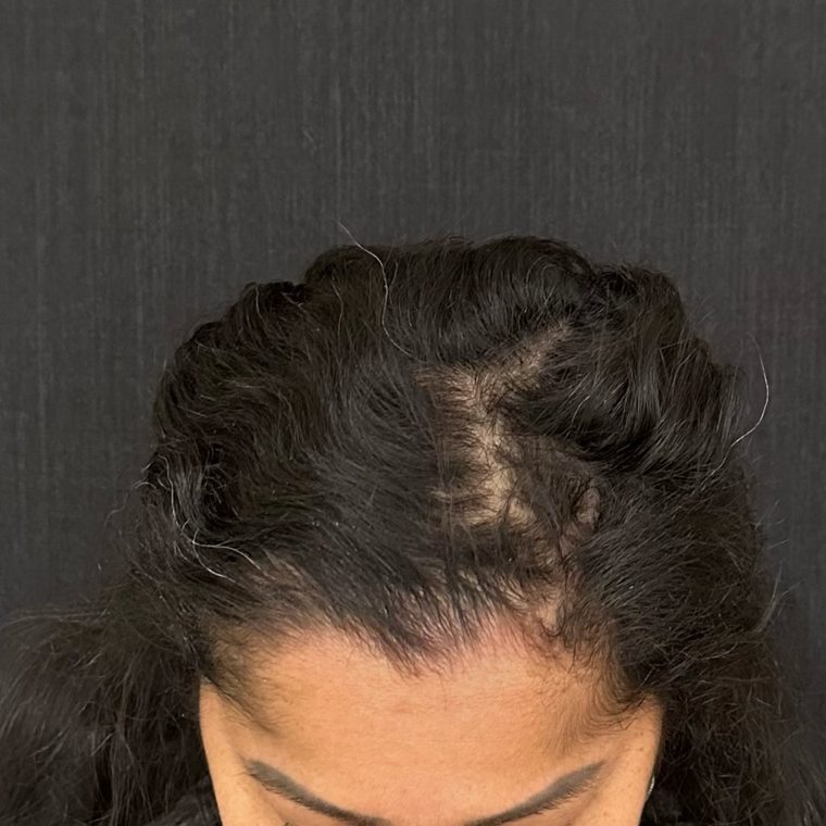 Tratamento para alopecia areata — depois